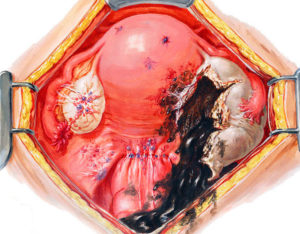 Беременность после удаления эндометриоидной кисты яичника