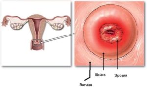 На какой день после месячных прижигают эрозию