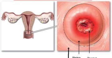 Симптомы при эрозии шейки матки у женщин
