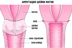 Удаление шейки матки при 3 степени дисплазии