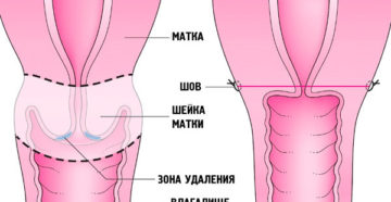 Удаление шейки матки при 3 степени дисплазии