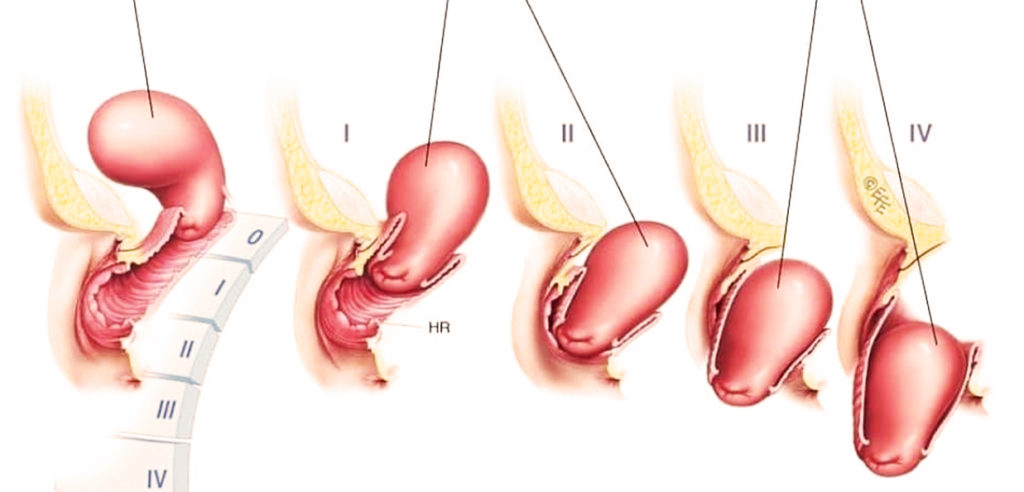 Признаки выпадения матки