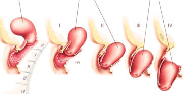 Признаки выпадения матки