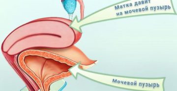 Матка давит на мочевой пузырь
