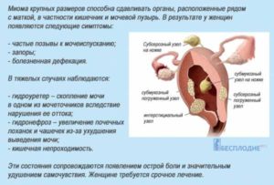 Симптомы миомы матки на ранних стадиях