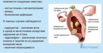 Симптомы миомы матки на ранних стадиях