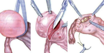Гормоны после удаления кисты яичника