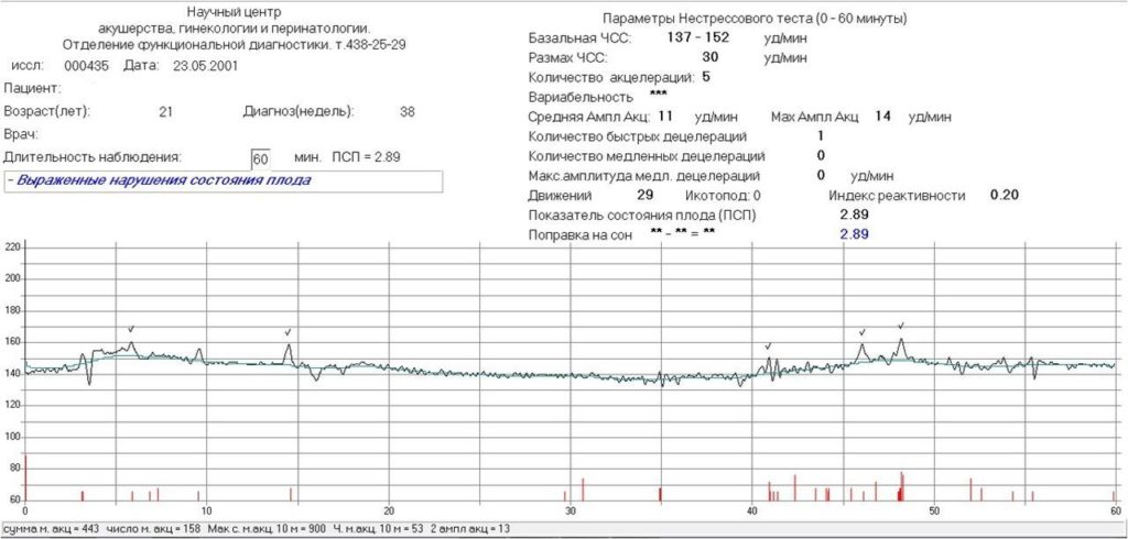 Начальное нарушение состояния плода ктг что это