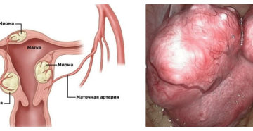 Чем опасна миома матки больших размеров