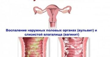 Вульвовагинит при беременности