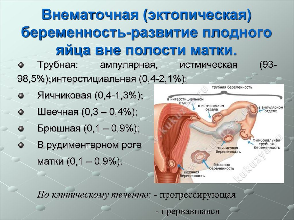 Эктопическая беременность что это такое