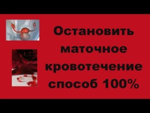 Как остановить маточное кровотечение в домашних условиях