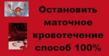 Как остановить маточное кровотечение в домашних условиях