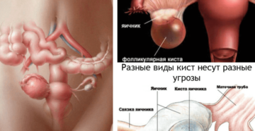 Может ли болеть киста яичника