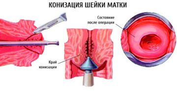 Что такое конизация шейки матки