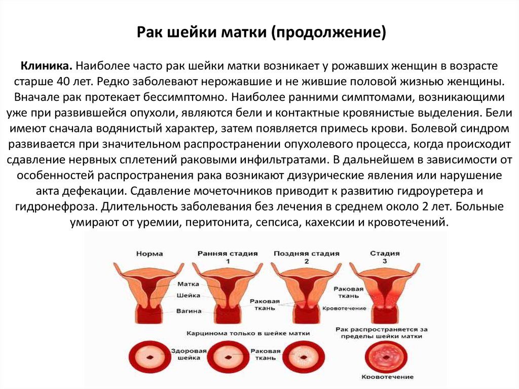 Как определить рак шейки матки