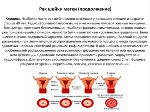 Как определить рак шейки матки