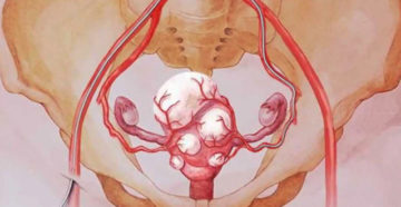 Миома матки после родов