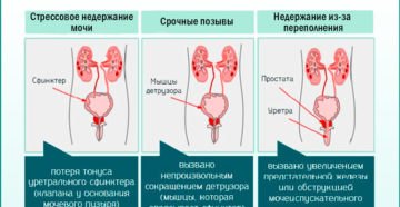 Подтекание мочи у женщин причины