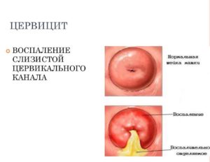 Симптомы воспаления цервикального канала