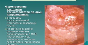 Симптомы и признаки дисплазии шейки матки