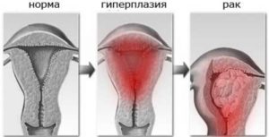 Симптомы гиперплазии эндометрия матки