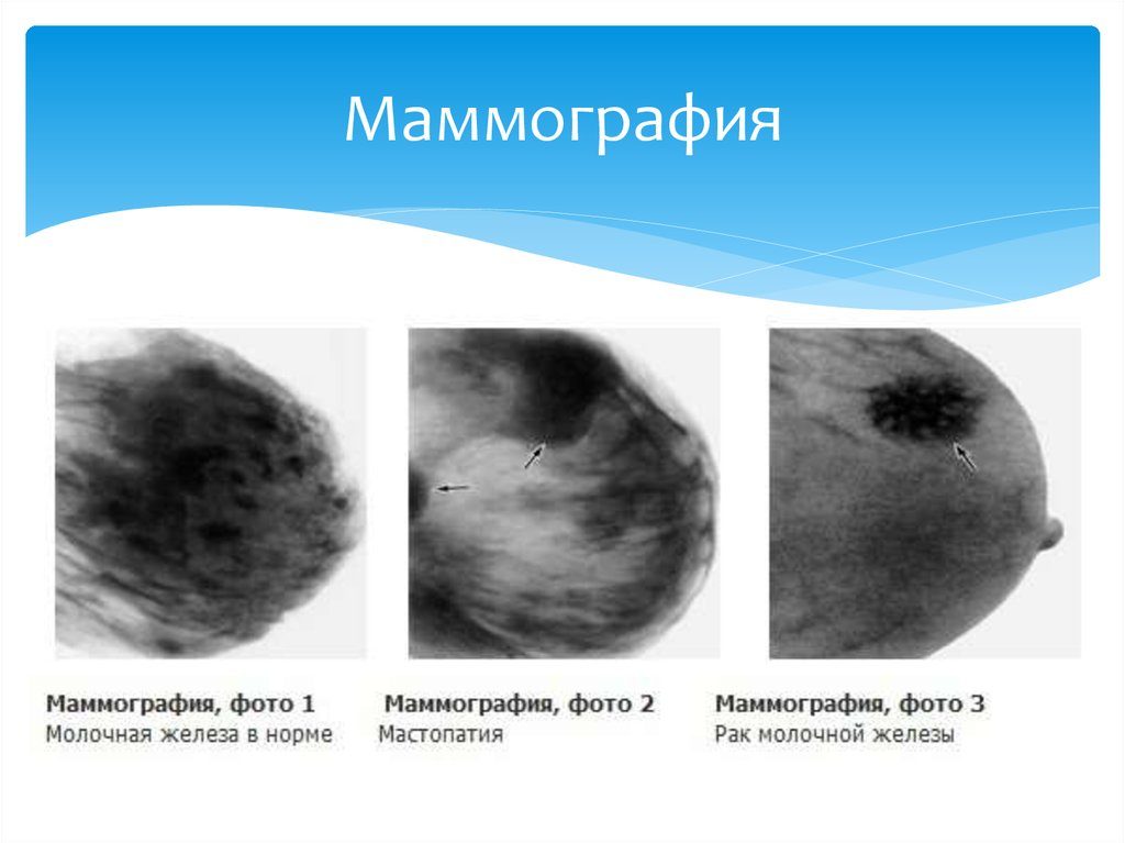 На какой день цикла делать маммографию