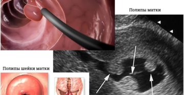 Применение Дюфастона при полипе в матке