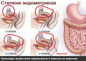 Симптомы эндометриоза кишечника