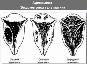 Что такое эндометриоз тела матки