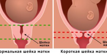 Длинная шейка матки при беременности