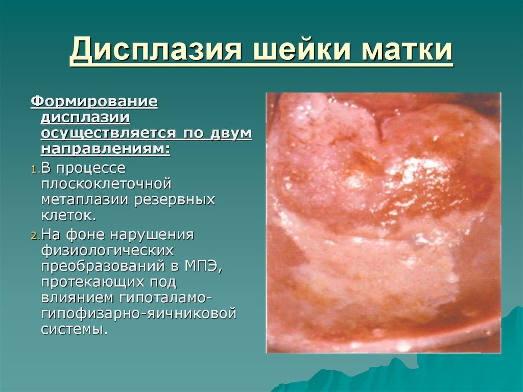 Методы лечения дисплазии шейки матки