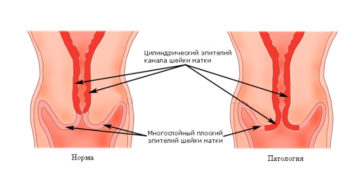 Цилиндрическая шейка матки