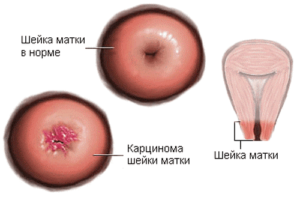 Симптомы и лечение папилломы матки