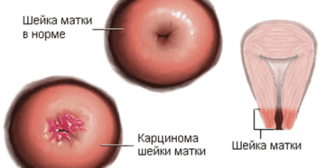 Симптомы и лечение папилломы матки