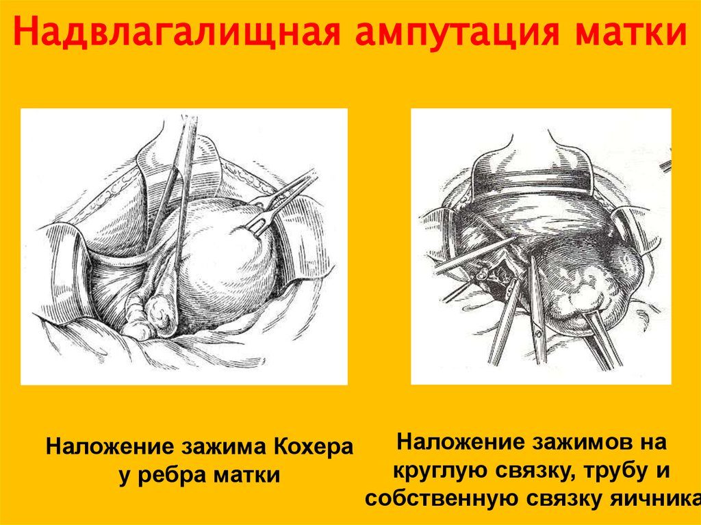 Что такое ампутация матки