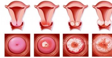Метаплазия шейки матки что это такое