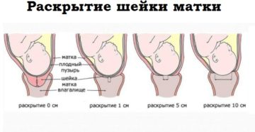 Почему не раскрывается шейка матки