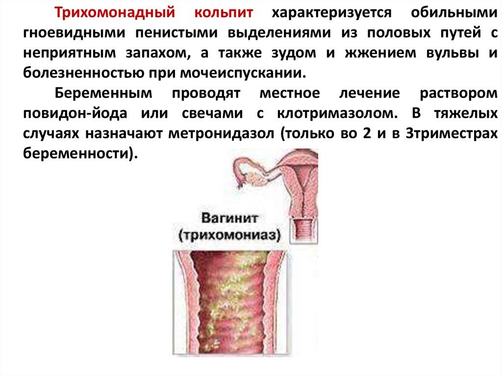 Трихомонадный кольпит симптомы и лечение у мужчин