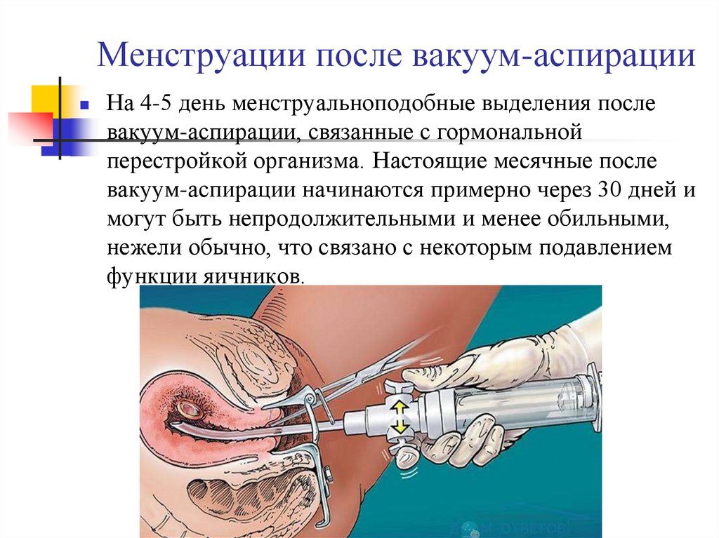 Месячные после вакуум аспирации