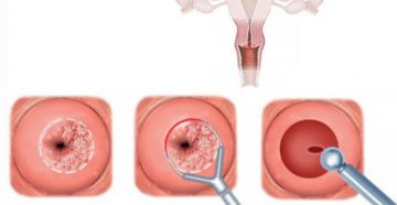 Биопсия шейки матки последствия