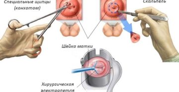 Биопсия шейки матки при эрозии