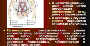 Куда метастазирует рак шейки матки