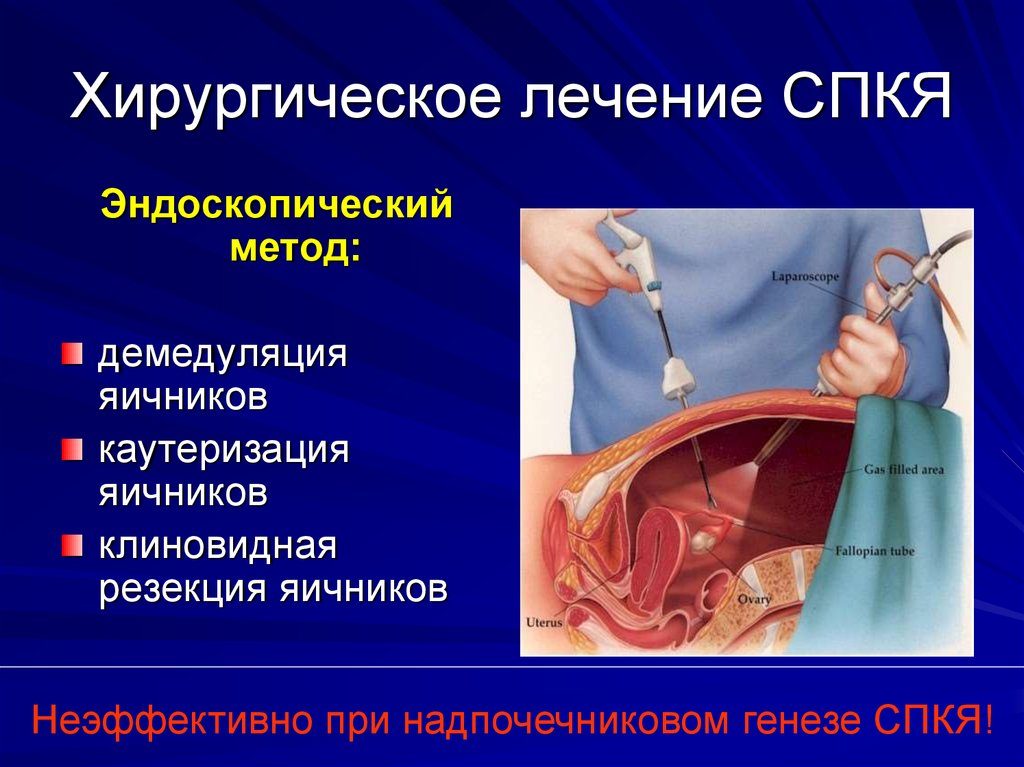 Техника диатермокаутеризация яичников при синдроме поликистозных яичников