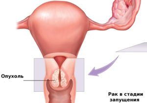 Неоплазия шейки матки
