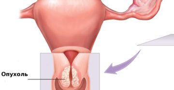 Неоплазия шейки матки