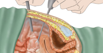 Операция по удалению эндометриоза матки