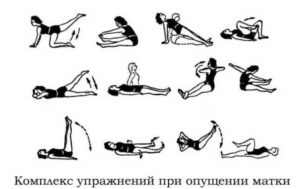 Упражнения Бубновского при опущении матки