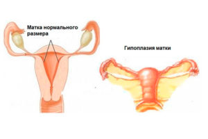 Что значит у женщины маленькая матка