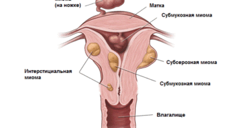 Интерстициально субсерозная миома матки что это такое